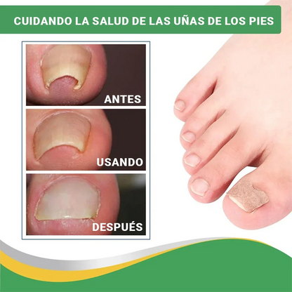 (PIDE 10 y LLEVA 20) Parches Para Hongos y Uñas Encarnadas - Encravax